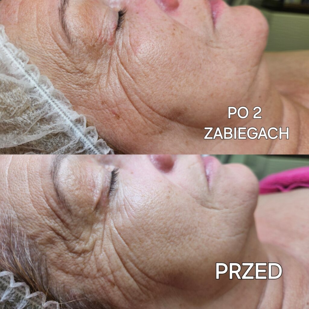 Mezoterapia mikroigłowa